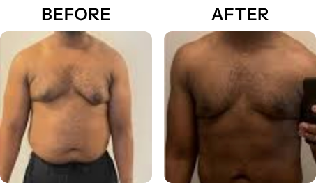 before and after results exopod lakeway michael